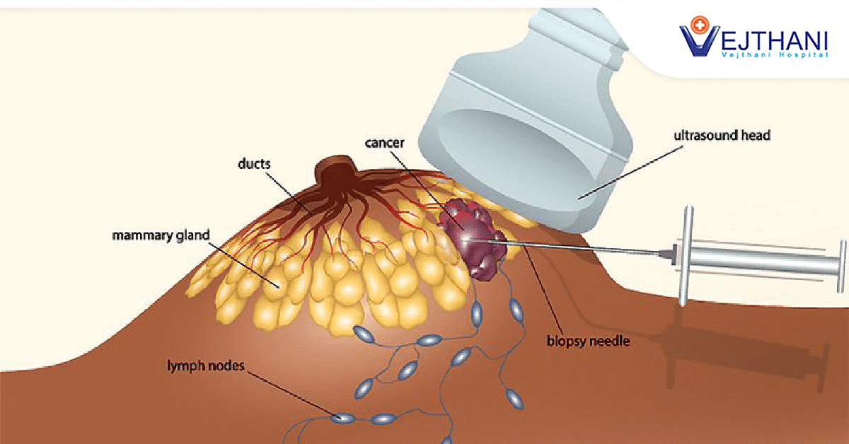 Breast Lump Biopsy: Addressing Anxiety and Uncertainty with Prompt Diagnosis