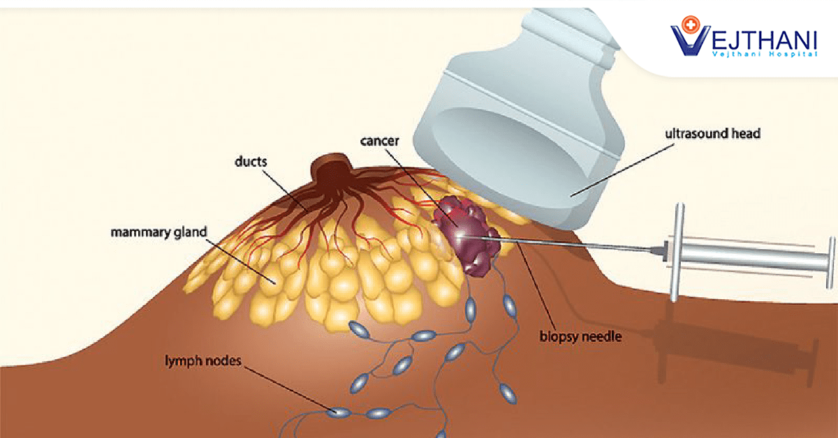 Sinh thiết khối u vú: Giải quyết sự lo lắng và sự không chắc chắn bằng chẩn đoán kịp thời