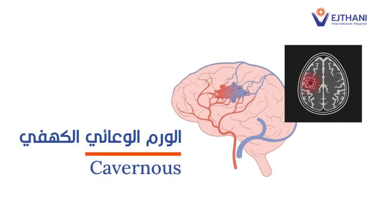 الورم الوعائي الكهفي