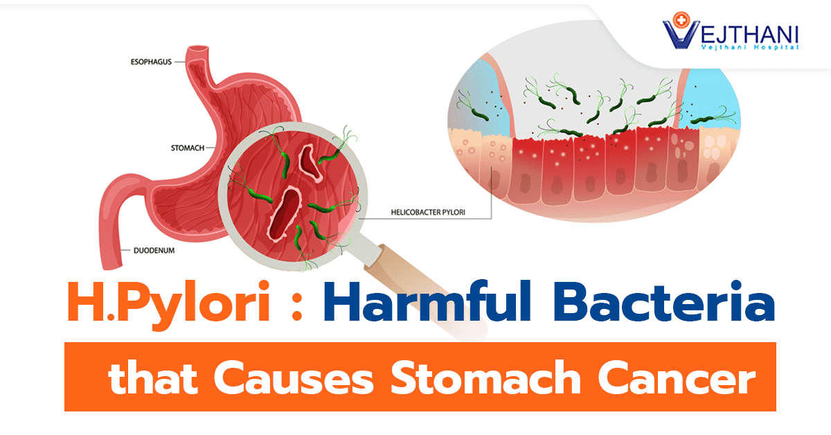 H.Pylori: Harmful Bacteria that Causes Stomach Cancer