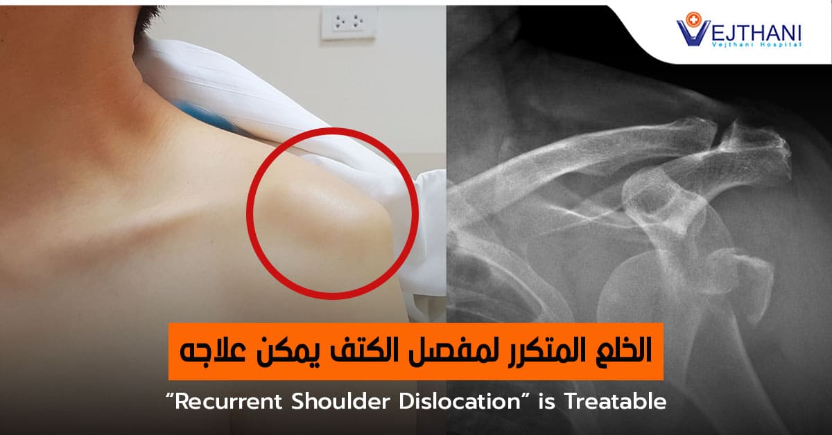 “الخلع المتكرر لمفصل الكتف” يمكن علاجه