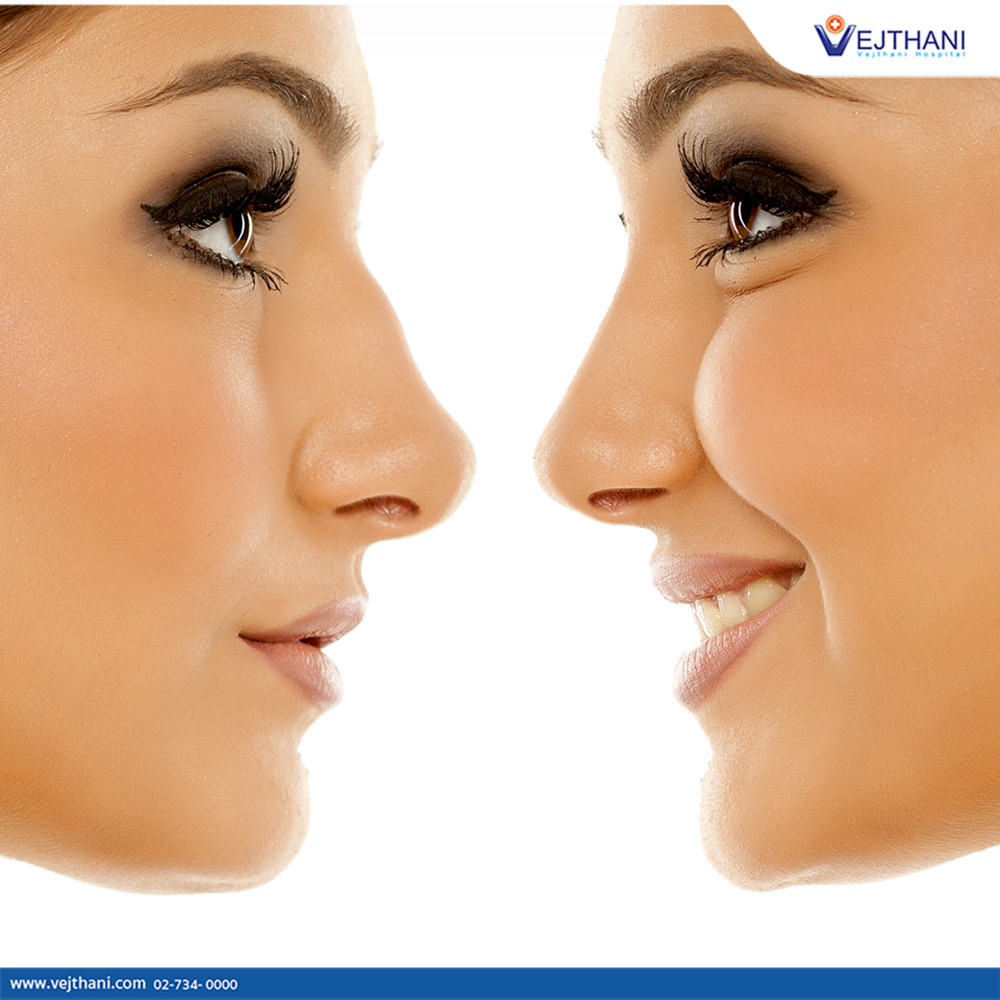 Rhinoplasty in Thailand can rid your nose of a bump