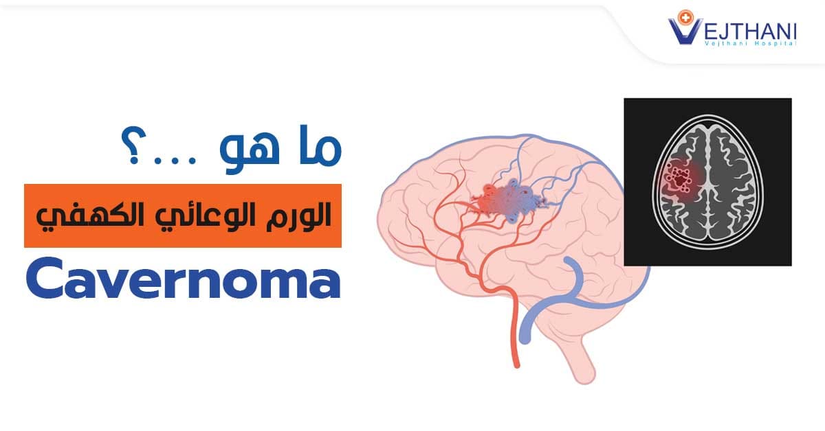 ما هو الورم الوعائي الكهفي ؟