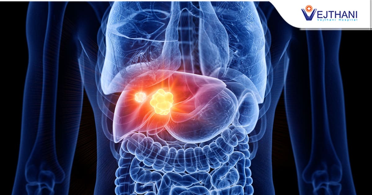 Transarterial Chemoembolization (TACE), Alternative Chemotherapeutic Agent Given Through Artry for Precise Liver Cancer Treatment