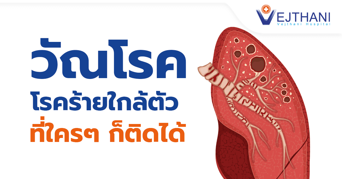 วัณโรค โรคร้ายใกล้ตัวที่ใครๆ ก็ติดได้