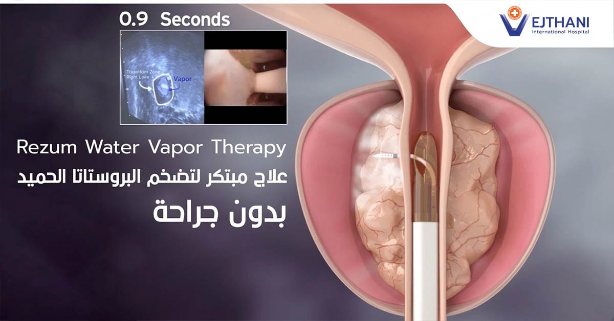 Therapy Vapor Water Rezum علاج مبتكر لتضخم البروستاتا الحمید بدون جراحة