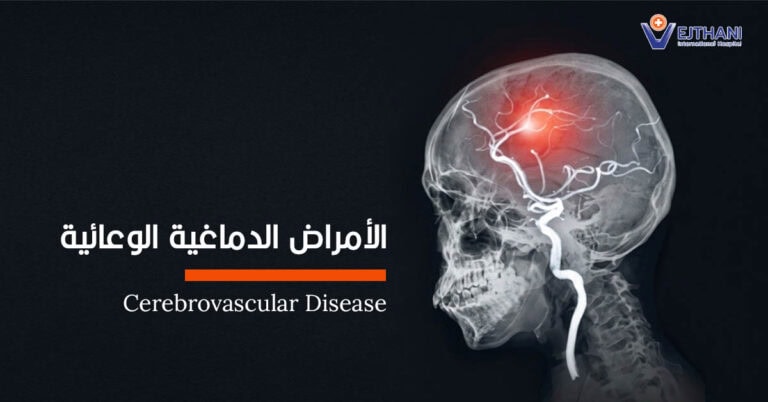 الأمراض الدماغية الوعائية