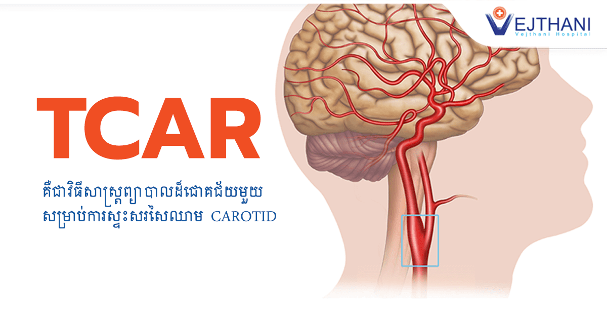គឺជាវិធីព្យាបាលដ៏ជោគជ័យមួយសម្រាប់ជំងឺសរសៃឈាម