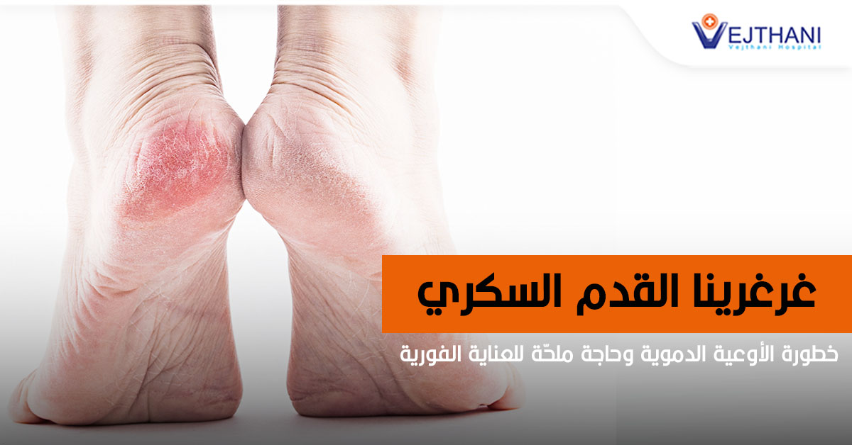 غرغرینا القدم السكري : خطورة الأوعیة الدمویة وحاجة ملحّة للعنایة الفوریة