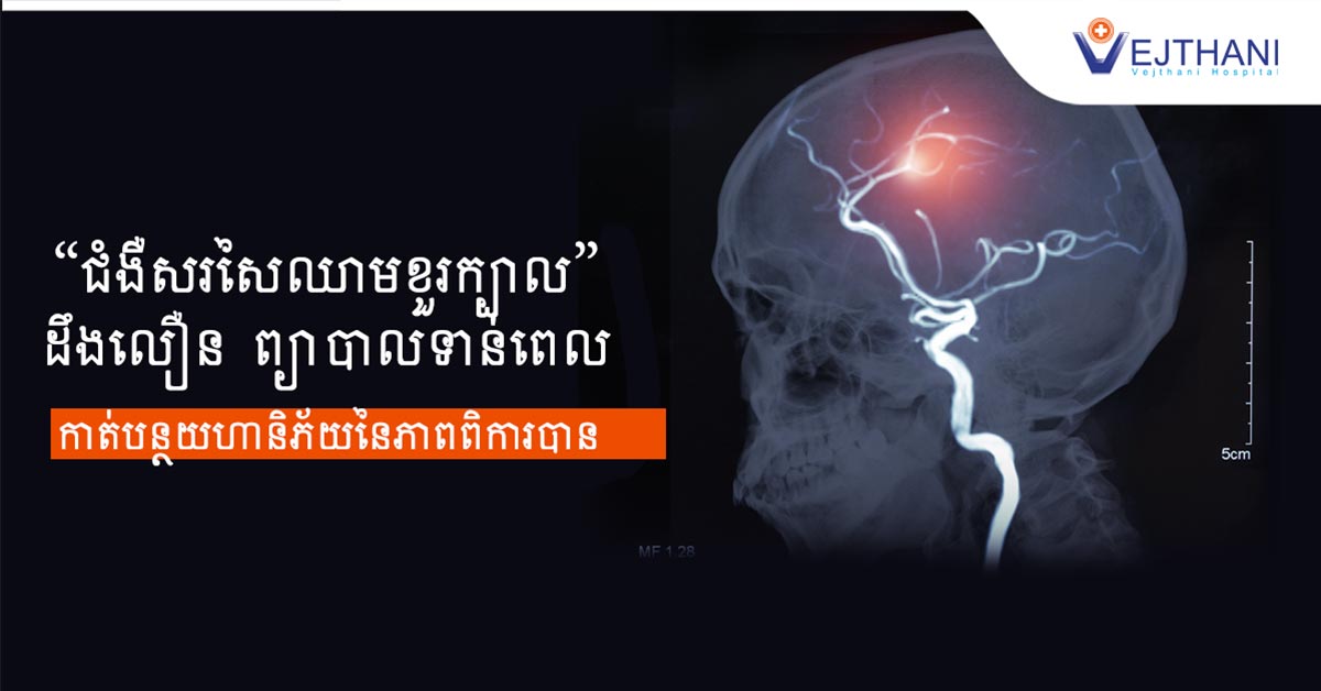 «ជំងឺ​សរសៃឈាម​ខួរក្បាល​» ដឹងលឿន ព្យាបាលទាន់ពេល អាចកាត់បន្ថយហានិភ័យនៃភាពពិការបាន