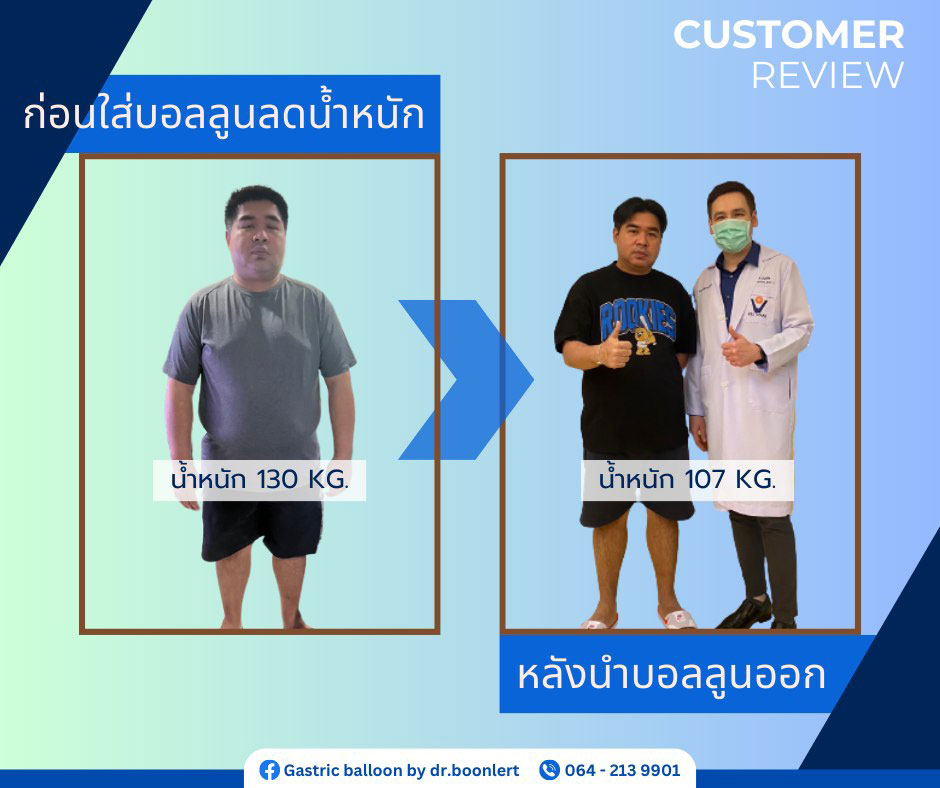 review Gastric Balloon 1