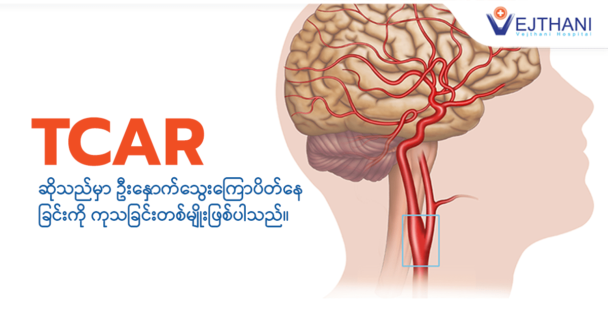 Transcarotid Artery Revascularization (TCAR) သည် carotid သွေးလွှတ်ကြောဆိုင်ရာရောဂါကို ကုသနိုင်သော ကုသမှုတစ်ခုဖြစ်ပါသည်