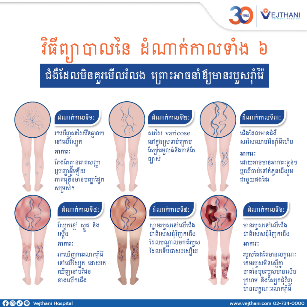 វិធីព្យាបាលនៃ ដំណាក់កាលទាំង ៦​ នៃជំងឺប៉ោងសរសៃវ៉ែន (Varicose)