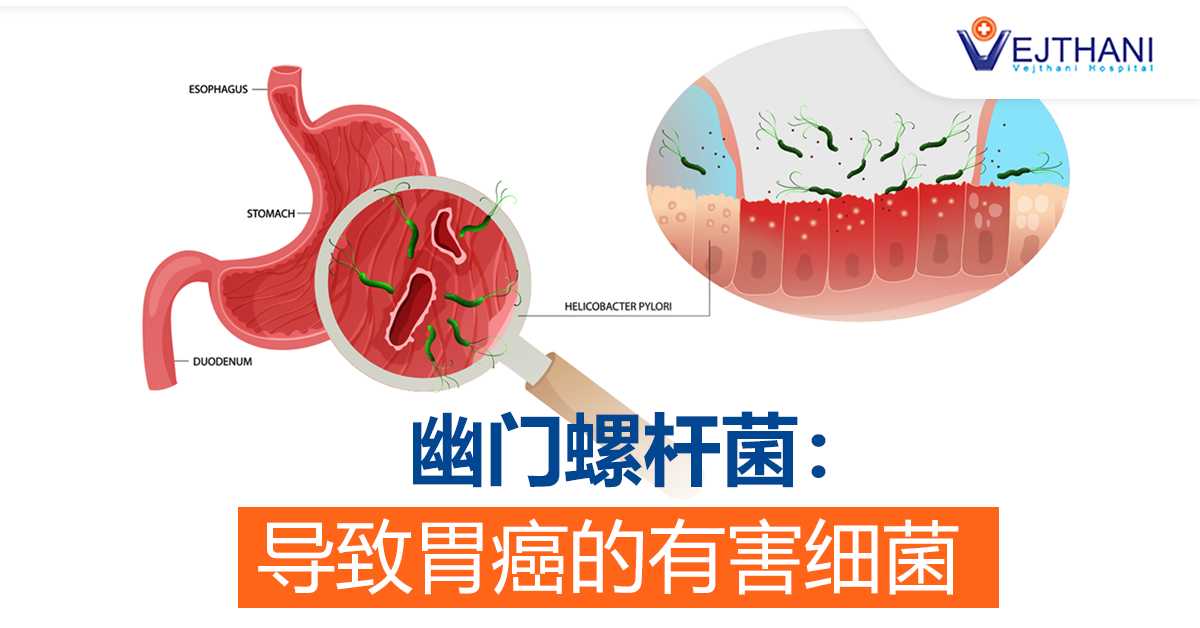 幽门螺杆菌：导致胃癌的有害细菌
