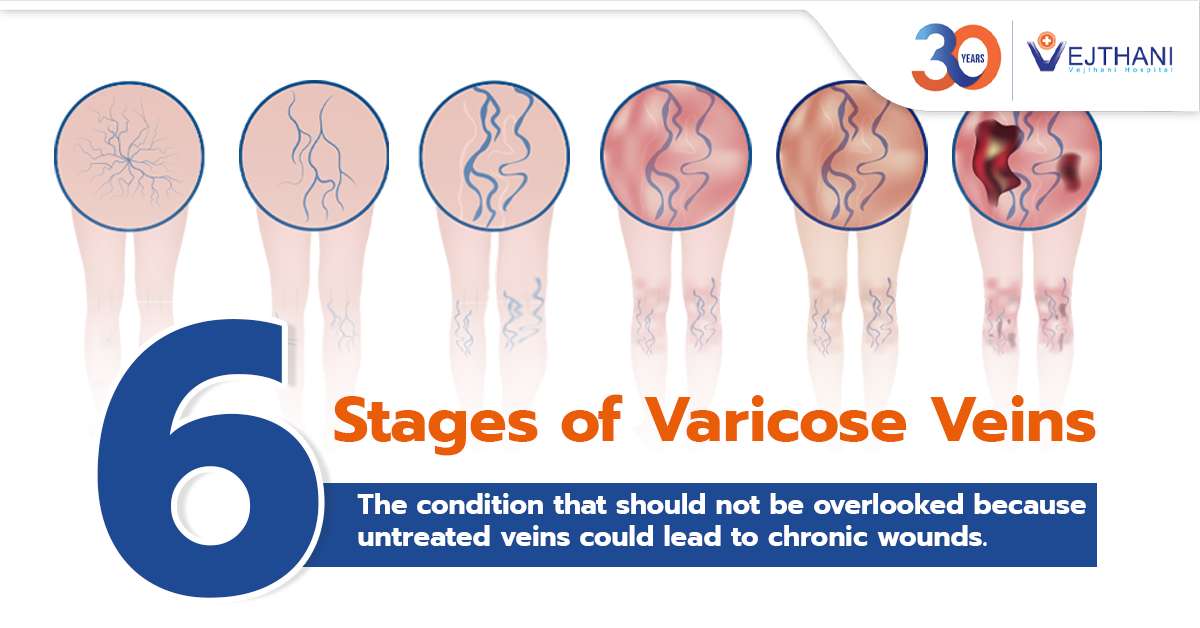 6 Stages of Varicose Veins and the Importance of Early Treatment