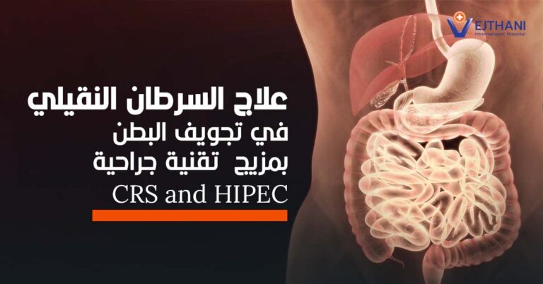 علاج السرطان النقيلي