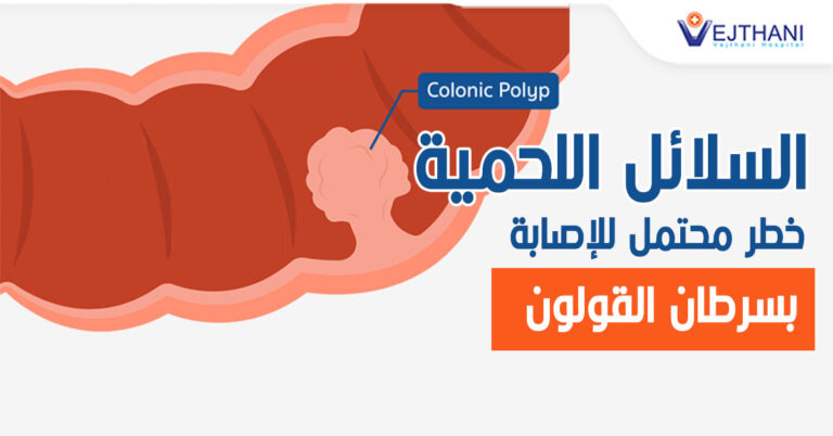 Colonic polyp