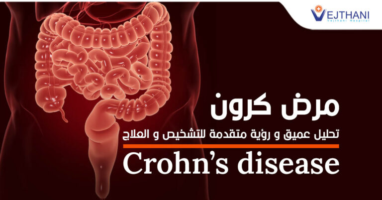 Crohn’s disease