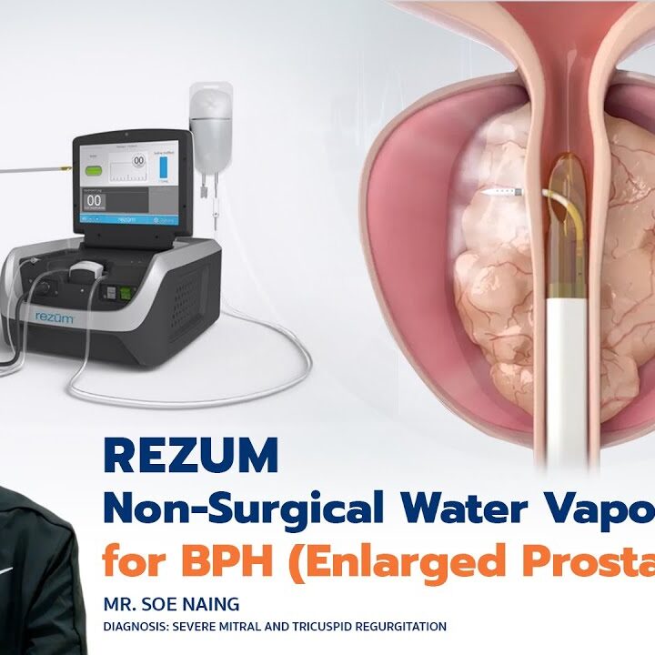REZUM Non-Surgical Water Vapor Therapy for BPH (Enlarged Prostate Gland)