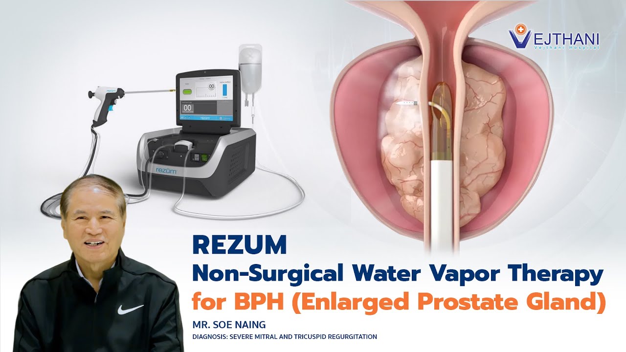 Rezum Treatment For Enlarged Prostate With Dr. Richard Levin REZUM Non-Surgical Water Vapor Therapy for BPH (Enlarged Prostate Gland)