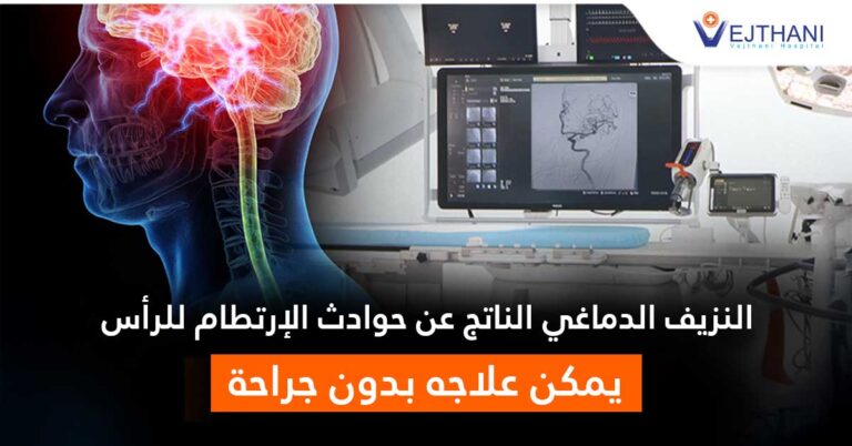 Explore Non-Surgical Treatment for Intracerebral Hemorrhage