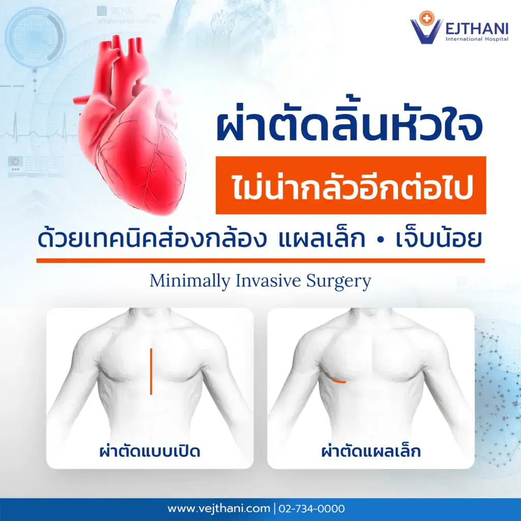 การผ่าตัดลิ้นหัวใจรั่วแบบแผลเล็ก