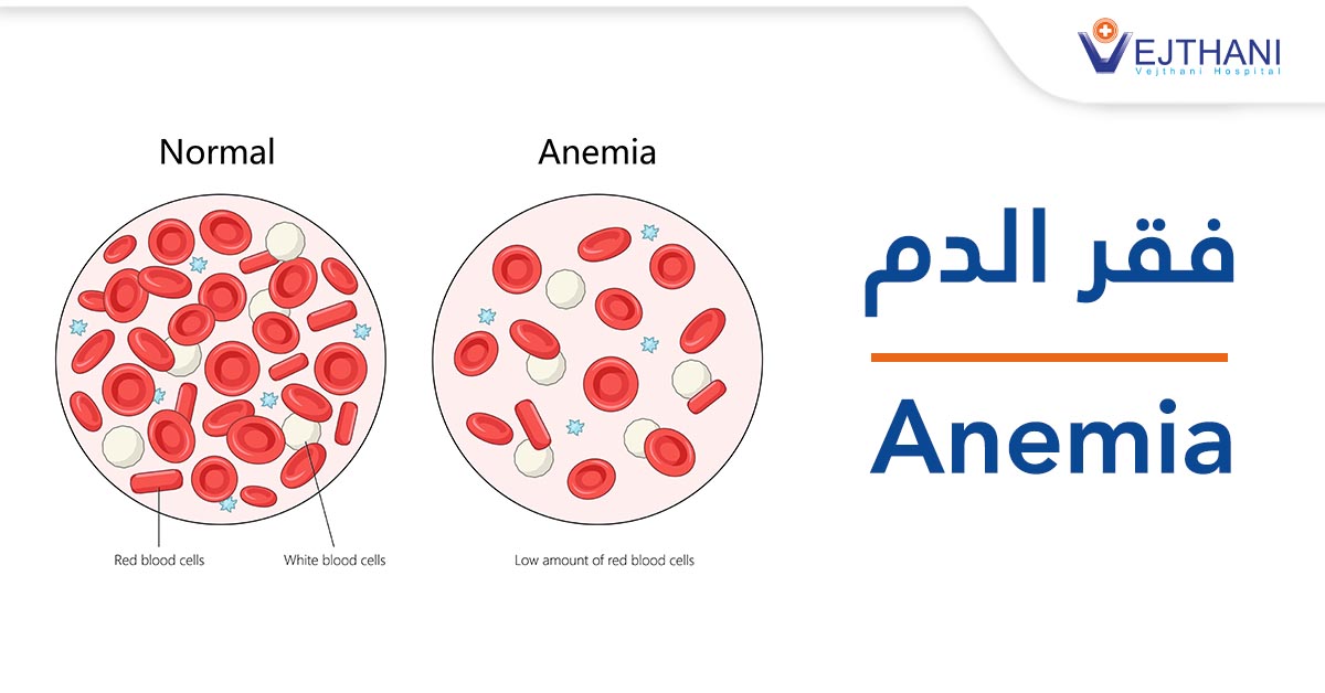 فقر الدم: دليل شامل لفهم أسبابه وأعراضه وطرق علاجه