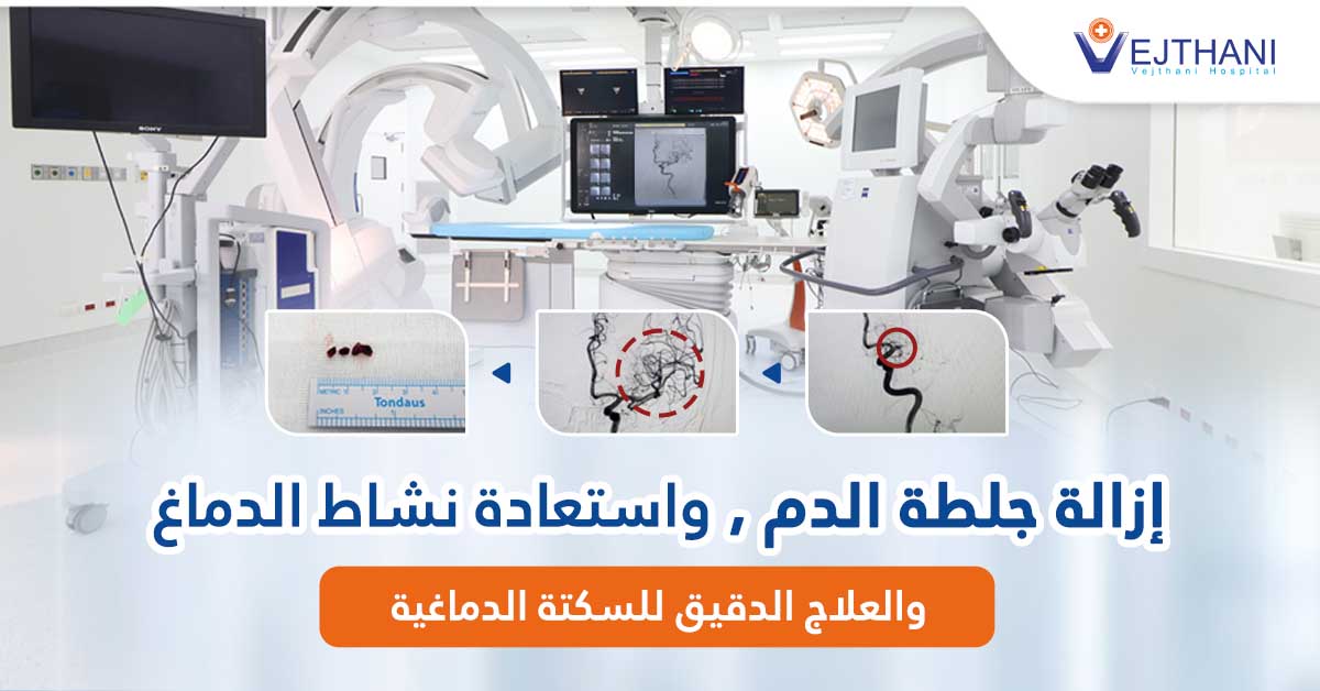 إزالة جلطة الدم، واستعادة نشاط الدماغ، والعلاج الدقيق للسكتة الدماغية