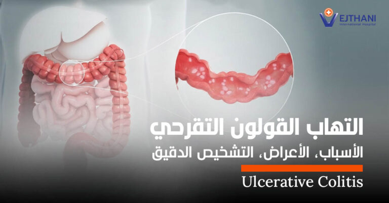 التهاب القولون التقرحي
