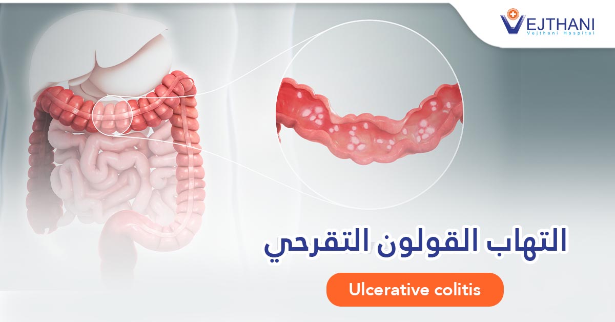 التهاب القولون التقرحي: الأسباب، الأعراض، التشخيص الدقيق، وأساليب العلاج الحديثة