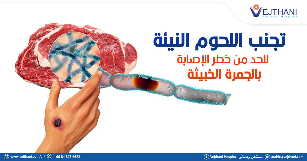 تجنب اللحوم النيئة للحد من خطر الإصابة بالجمرة الخبيثة