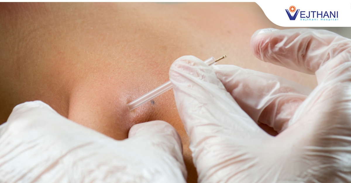 หยุดความปวดจากออฟฟิศซินโดรม ด้วยการฝังเข็ม Dry Needling