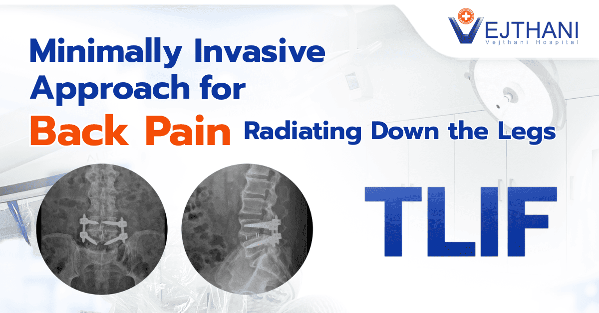 Say Goodbye to Back Pain Radiating to the Legs with MIS-TLIF