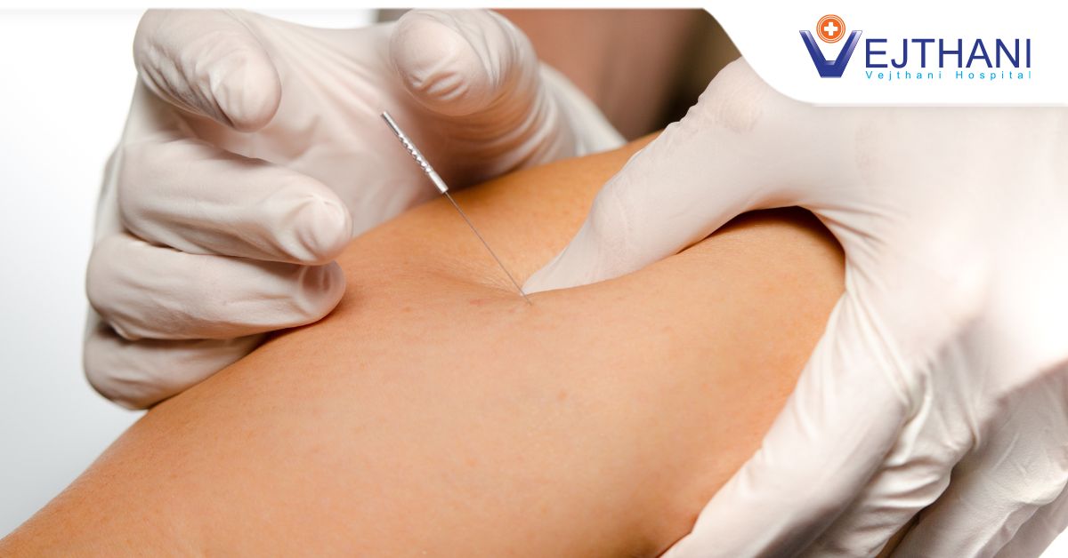 หยุดความปวดจากออฟฟิศซินโดรม ด้วยการฝังเข็ม Dry Needling