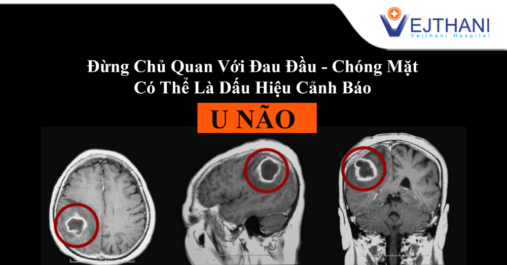 Đừng chủ quan với các cơn đau đầu hoặc chóng mặt vì đây có thể là dấu hiệu của u não