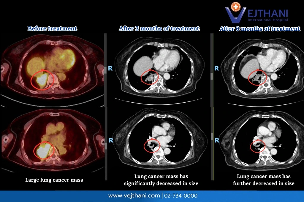 CT scan images highlighting RET fusion lung cancer and precise treatment using Next-Generation Sequencing (NGS) at Vejthani International Hospital.