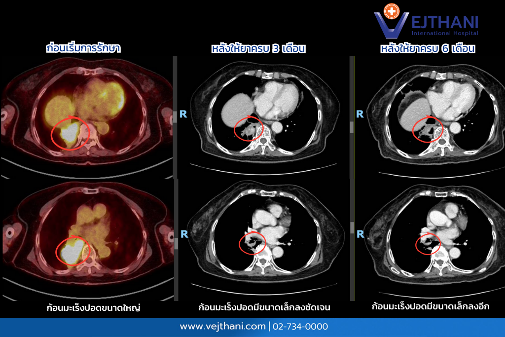 เทคโนโลยี Next-Generation Sequencing (NGS) ช่วยถอดรหัสพันธุกรรมของเซลล์มะเร็งเพื่อการรักษาที่แม่นยำ
