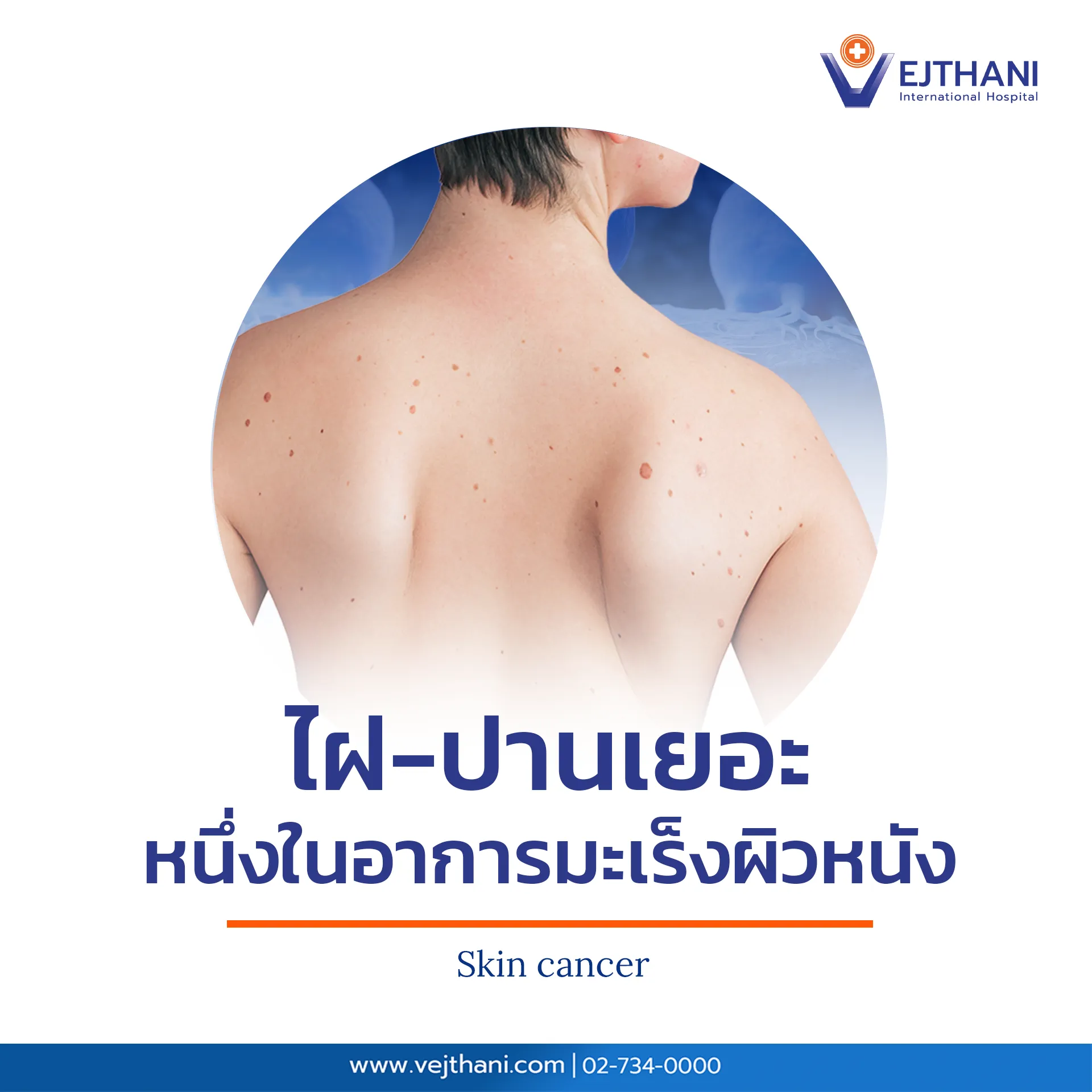 แผ่นหลังผู้หญิงมีไฝและปานจำนวนมาก อาจเป็นสัญญาณของมะเร็งผิวหนัง