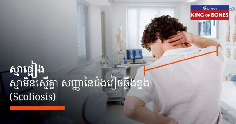 ស្មាមិនស្មើគ្នា ឬស្មាផ្អៀង គឺជាស្ថានភាពមួយដែលស្មាទាំងពីរមិនស្មើគ្នានៅពេលឈរ ឬអង្គុយត្រង់ ស្មាម្ខាងខ្ពស់ជាង ឬទាបជាងស្មាម្ខាងទៀត ស្ថានភាពនេះអាចនាំឱ្យមានការឈឺចាប់រ៉ាំរ៉ៃនៅក ស្មា និងខ្នងផ្នែកខាងលើ