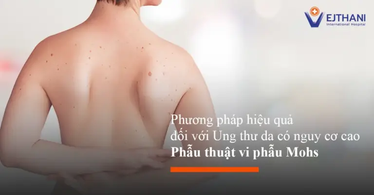 Phẫu thuật Mohs là một phương pháp cắt bỏ ung thư da rất chính xác. Bác sĩ sẽ loại bỏ từng lớp mô ung thư và kiểm tra ngay dưới kính hiển vi. Nhờ đó, phương pháp này đặc biệt hiệu quả cho những trường hợp ung thư da nguy cơ cao, giúp loại bỏ triệt để và giữ lại tối đa mô lành.
