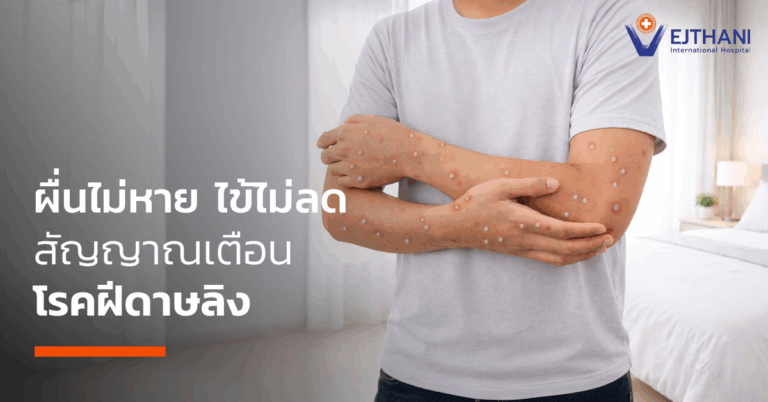 โรคฝีดาษลิง