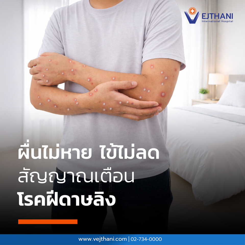 โรคฝีดาษลิง