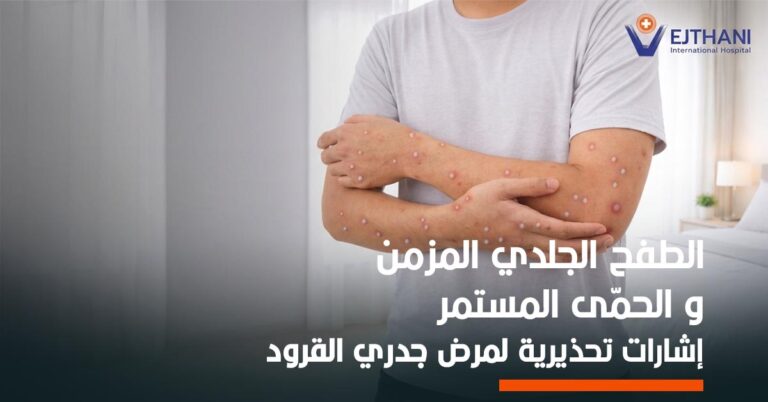 جدري القرود