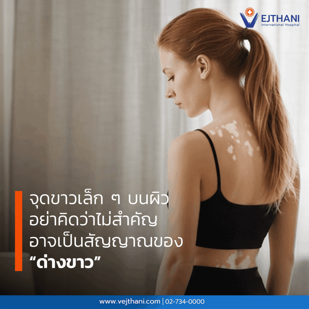 ด่างขาว