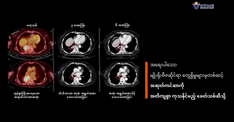 အဆုတ်ကင်ဆာRETကုထုံး