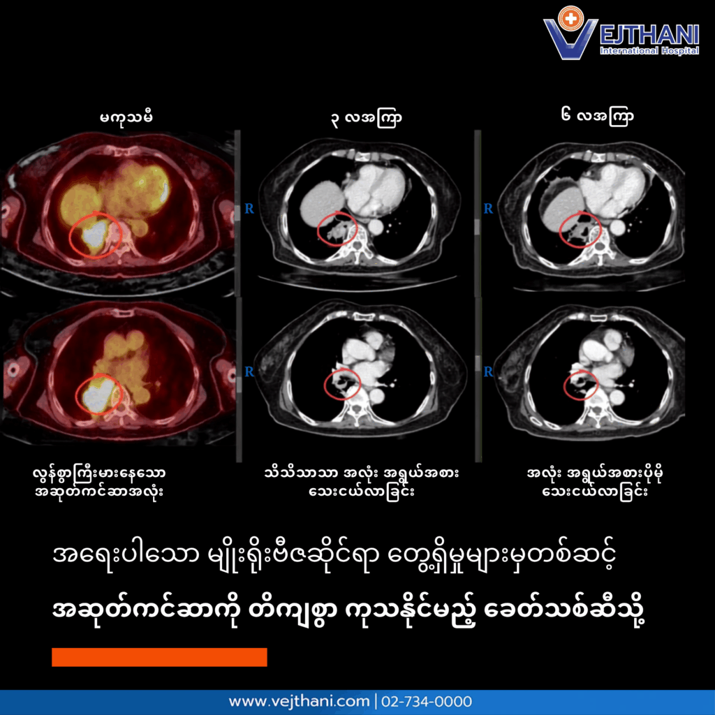 အဆုတ်ကင်ဆာRETကုထုံး