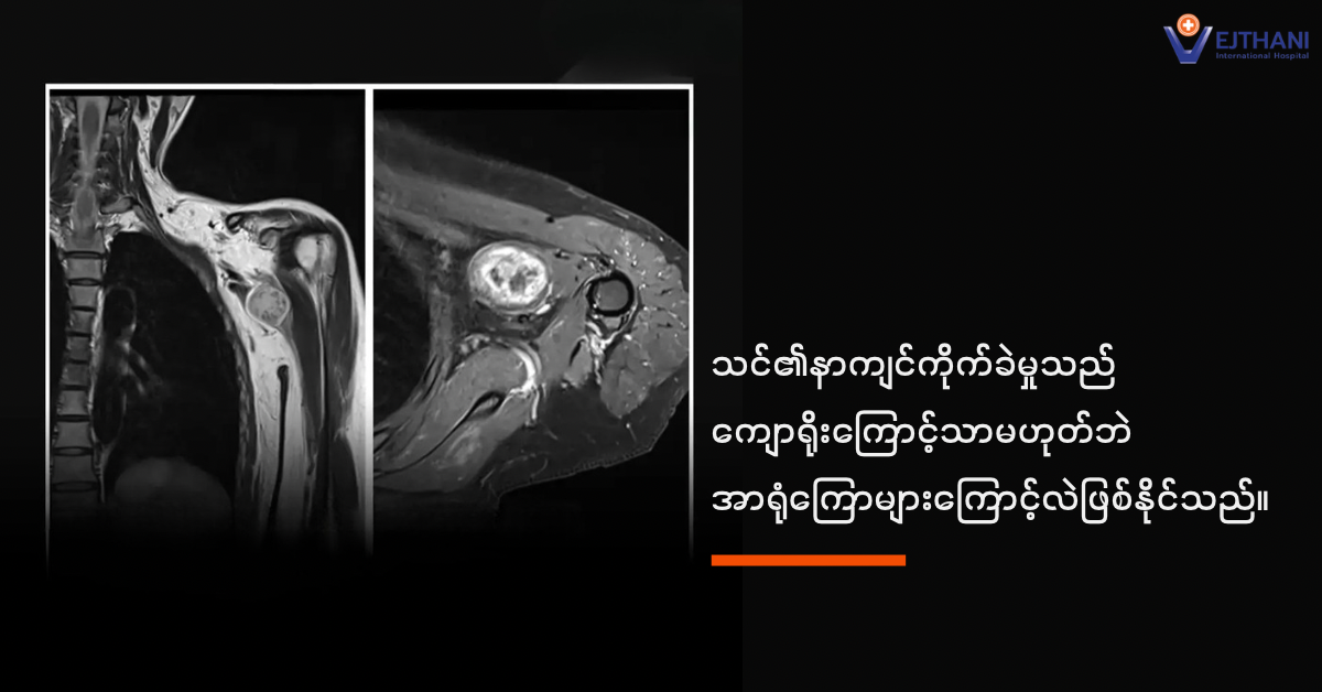 အာရုံကြောအကြိတ်