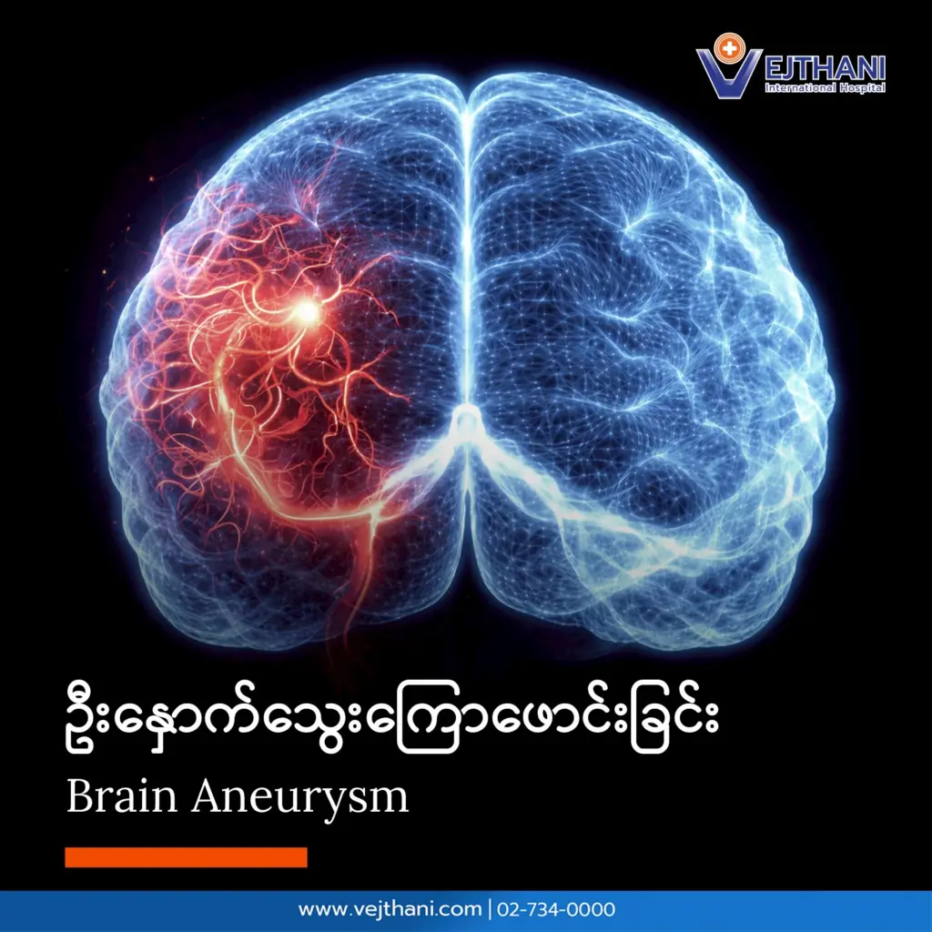 ဦးနှောက်သွေးကြောဖောင်းခြင်း