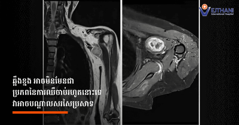 The Spine Isn’t Always the Source of Your Pain, It May Be the Nerves (Web)
