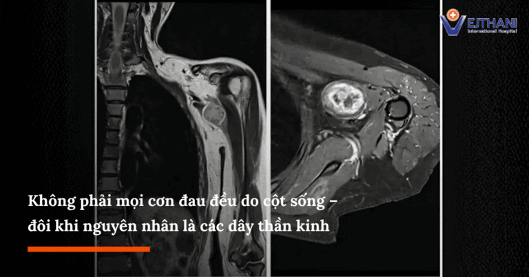 Đau vai, tê cánh tay mãi không khỏi? Đừng bỏ qua bệnh lý dây thần kinh